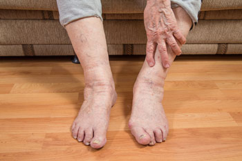 Geriatric foot care in the Ocean County, NJ: Toms River (Brick Township, Jackson Township, Berkeley Township, Lacey Township, Ocean Township, Beachwood) areas