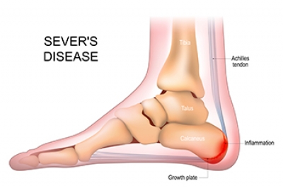 Causes of Sever’s Disease